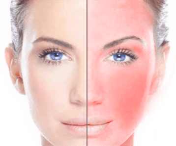 Top 5 Treatments for Rosacea