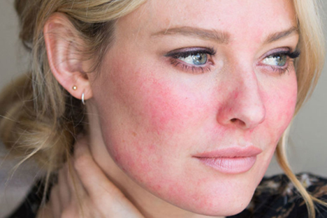 rosacea