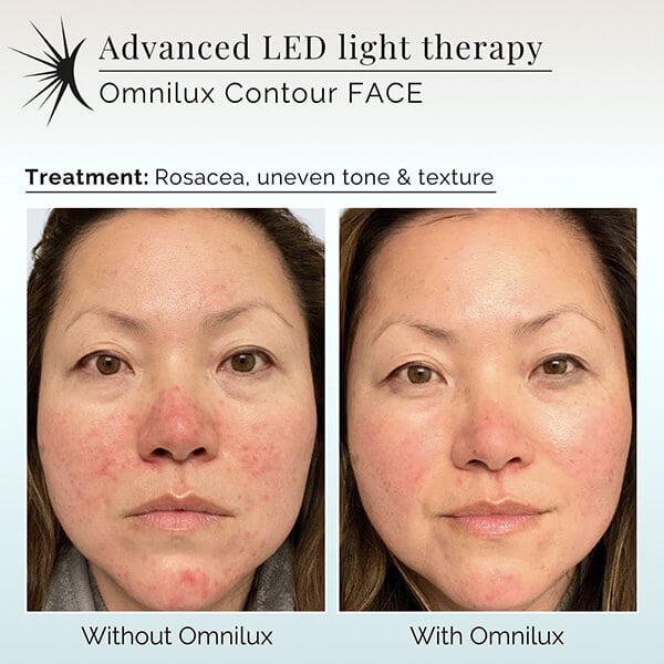 LED Light Therapy Facial: The Ultimate Guide