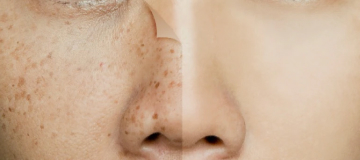 pigmentation