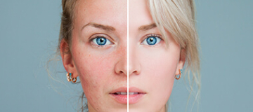 rosacea