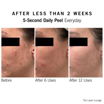 NEOVA SmartSkincare 5-Second Daily Peel - 30 pads