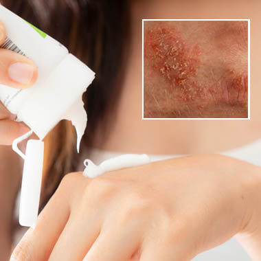 Eczema 
