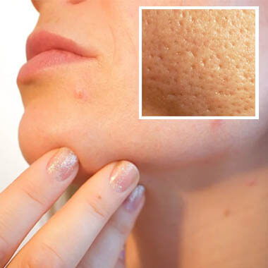 Enlarged Pores