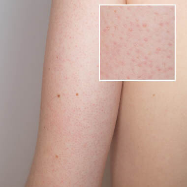 Keratosis Pilaris 