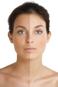 FAQ's  - I tried everything to treat my pigmentation
