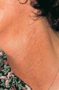 poikiloderma_of_civatte5