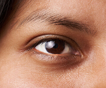 Expert Tips For Dark Circles Under The Eyes 