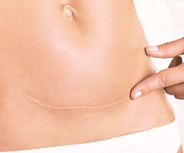 Do Silicone Scar Treatments Work on Old Scars?