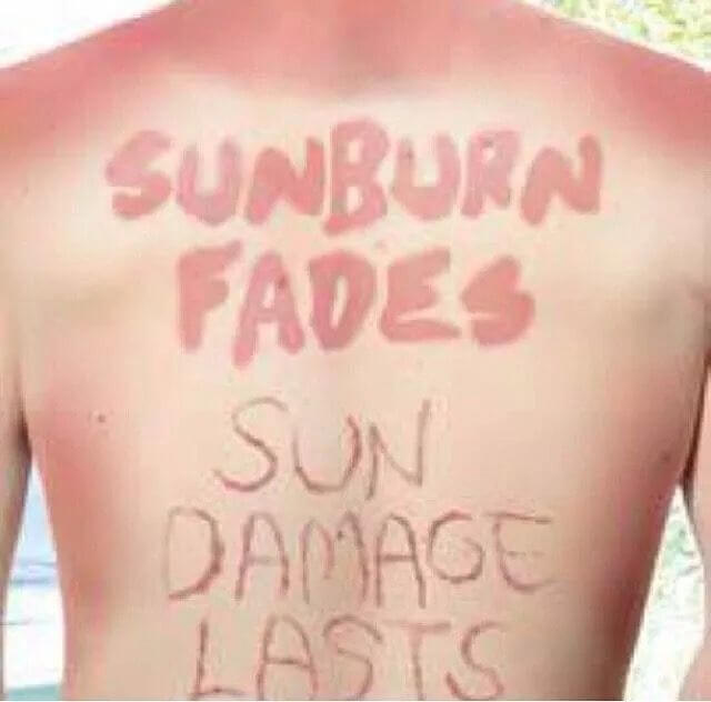 sunburn