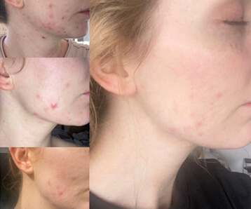 Stacey's Skincare Journey