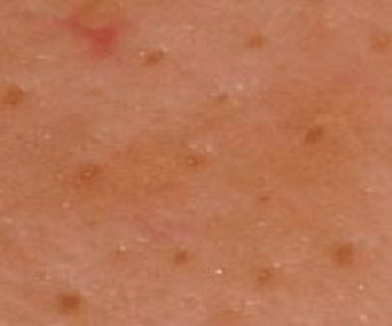 Understanding and managing enlarged pores for smoother skin