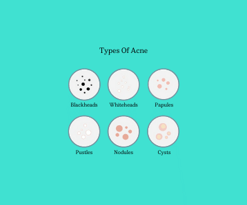 ACNE 101 - Different Types of Acne & How to Treat Them