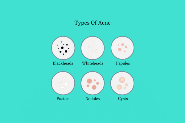 Types Of Acne