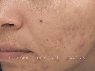 PCA SKIN ACNE GEL BEFORE & AFTER