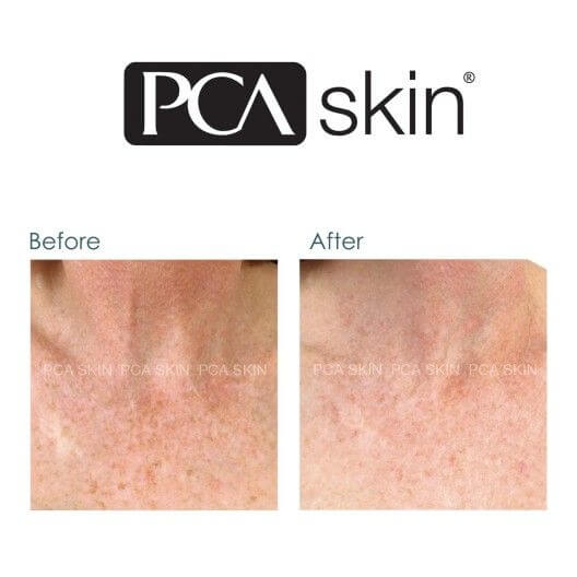 pca skin before and after