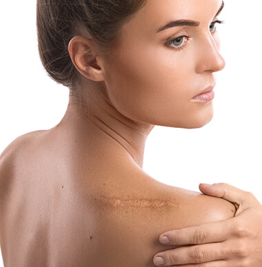 Scar treatments