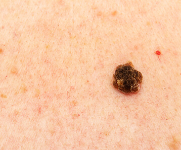 Learn more about Moles