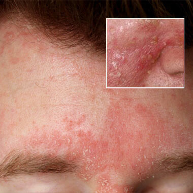 seborrheic dermatitis