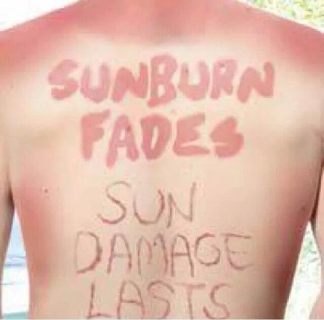 sun burn