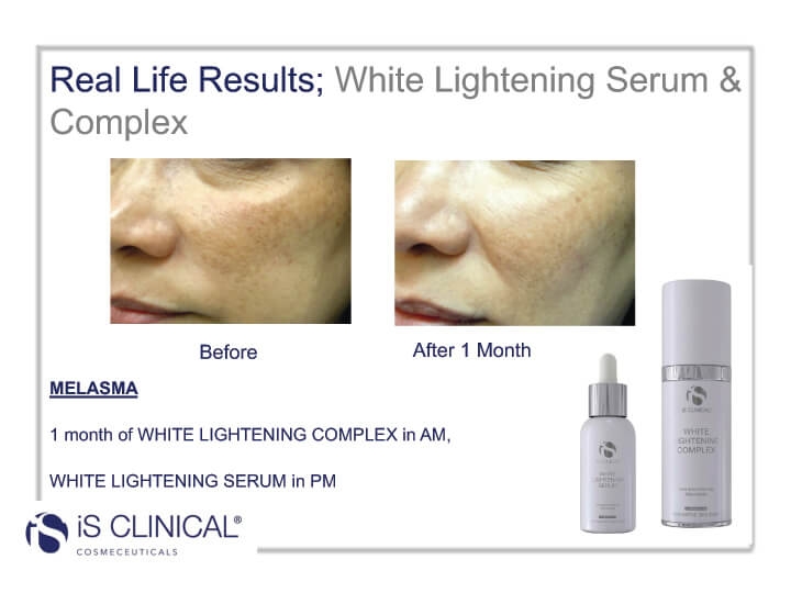 White Lightening Complex White Lightening Complex