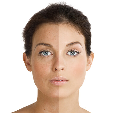 Pigmentation Treatments Pigmentation Treatments