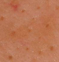 Enlarged Pores