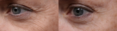before and after eyes image
