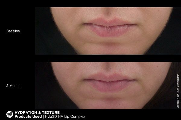 Jan Marini Hyla3D | HA Lip Complex | Marini SkinSolutions