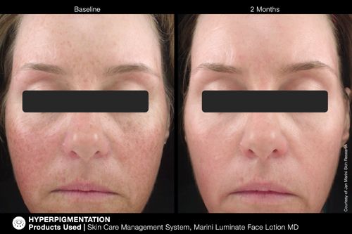 jan Marini Luminate serum before and after