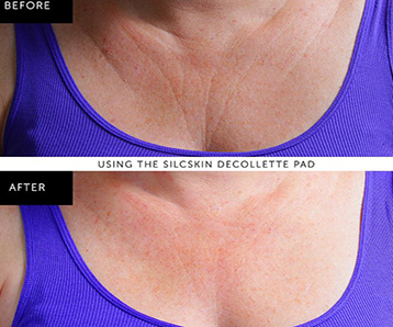 Do Silicone Pads Get Rid Of Wrinkles?