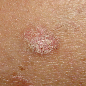 Actinic Keratosis