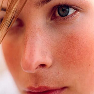 Redness & Rosacea
