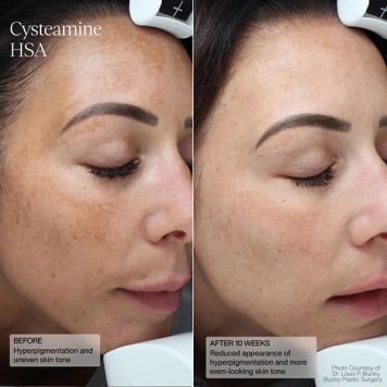 Sente Pigment & Tone Correcting Mask - Cysteamine + HSA  