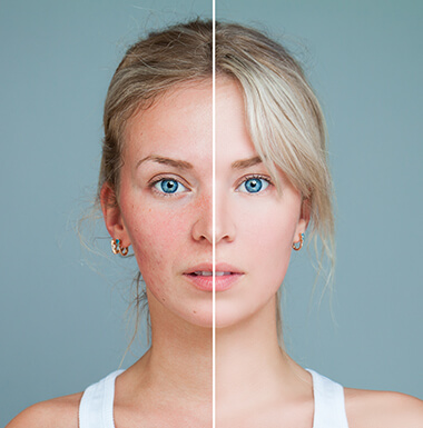 Rosacea Treatment