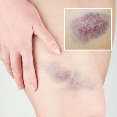 Bruise Cream