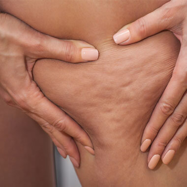 Cellulite Treatments