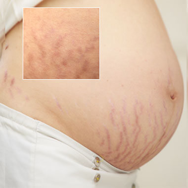 Stretch Mark Treatments