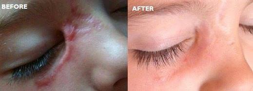 Check out the before & after images from using Pro-sil scar stick!