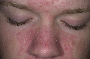 Skincare to Help Seborrheic Dermatitis
