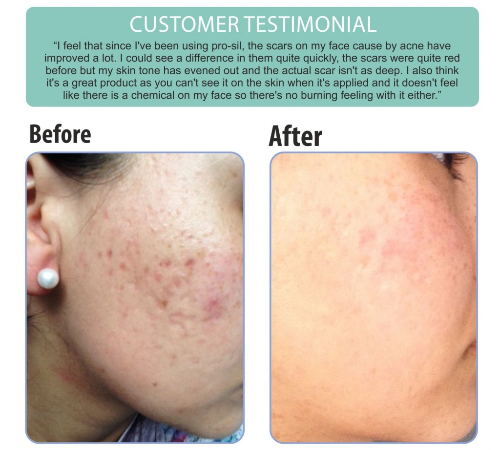 Look at the amazing results from using pro-sil scar stick