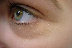 Milia: Causes and Treatments