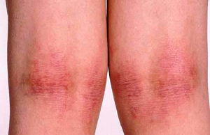 What is eczema?