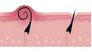 Why do we get Ingrown hairs?