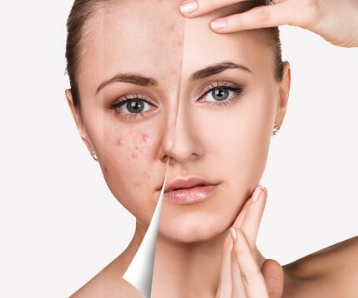 How To Treat Quarantine Breakouts