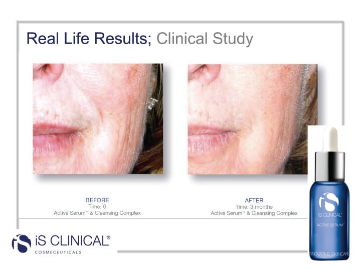 iS Clinical Active Serum before and after photos iS Clinical Active Serum before and after photos