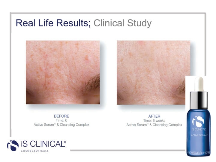 is Clinical Active Serum & Cleansing Complex before and after photos is Clinical Active Serum & Cleansing Complex before and after photos