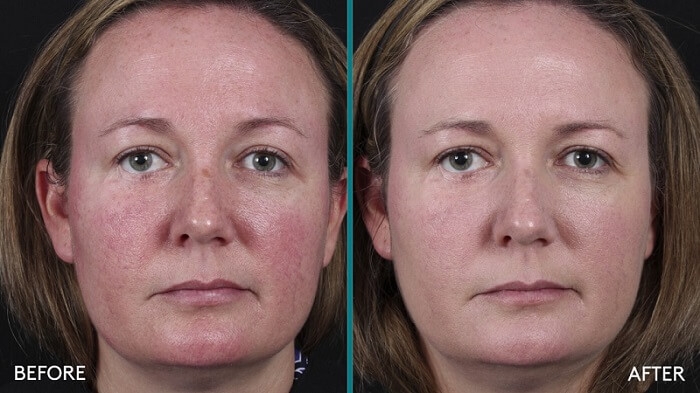 all calm before and after image