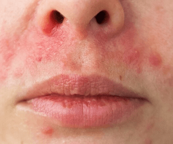 Perioral dermatitis - Symptoms, Causes, and Treatment