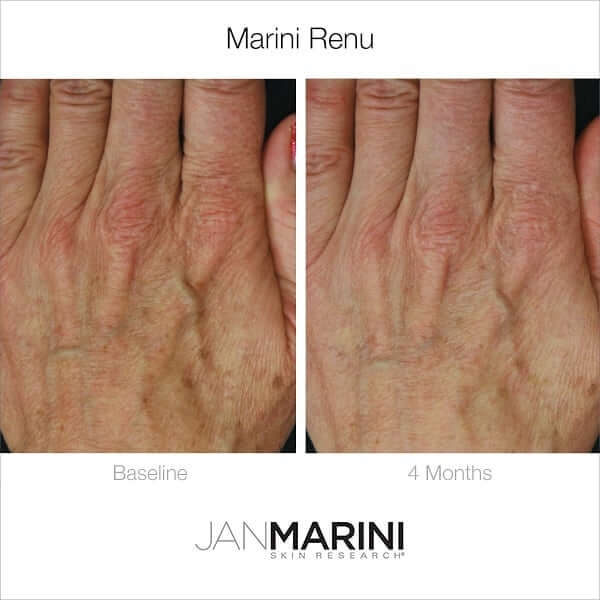 jan marini renu hand before and after image